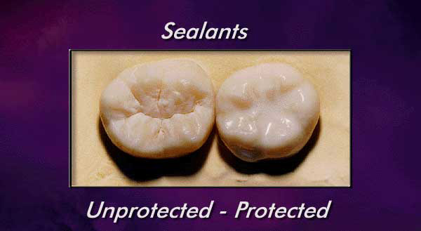 How Much Are Dental Sealants?